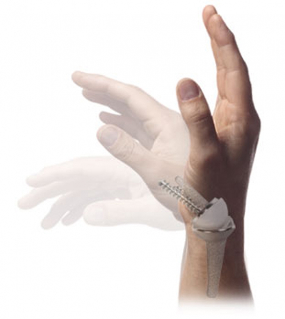 Endoprothetik - Kompetenzen - Hand- & Rheumachirurgie - Fachabteilungen -  Medizin & Pflege